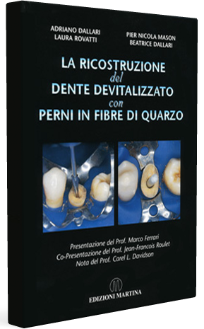 ricostruzione-dente-devitalizzato-perni-fibre-quarzo